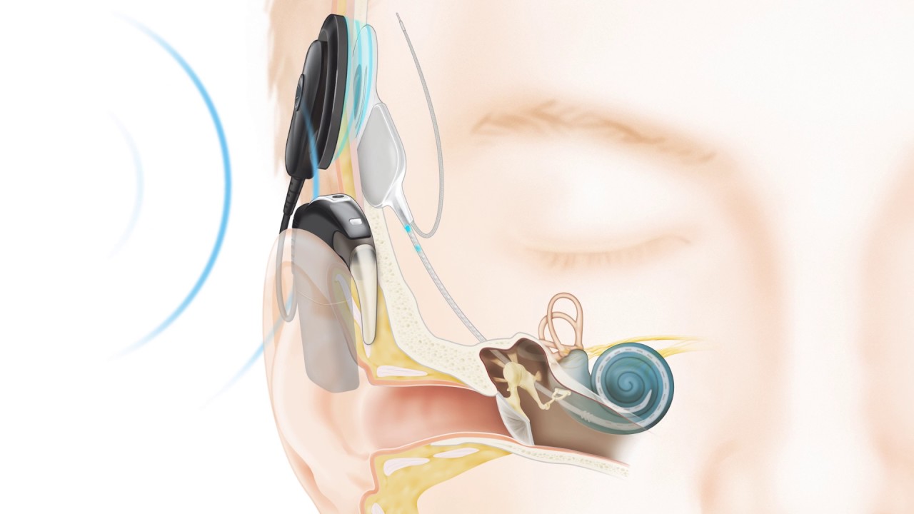 implantcochlear